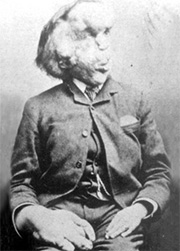 A Wikipedia picture of Joseph Merrick.